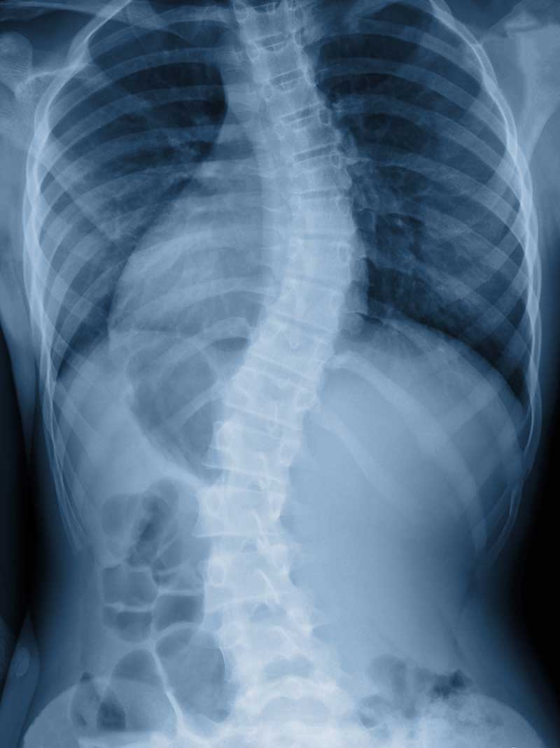 Scoliosis Longview, TX